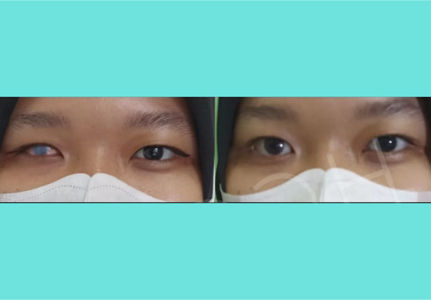 Knoch 3D Artificial Eye